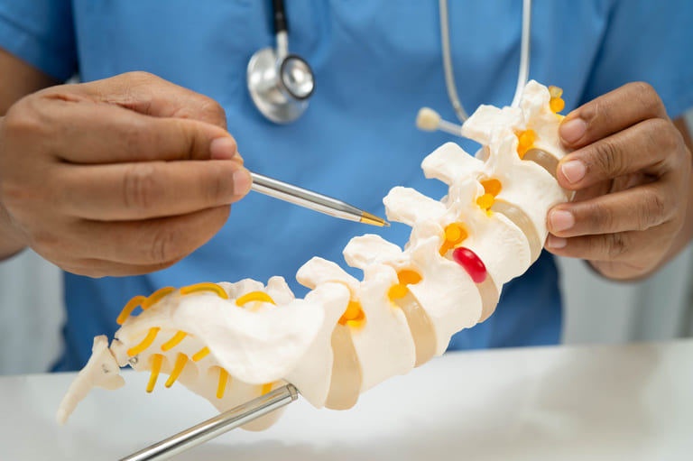 Bandscheibenvorfall behandeln ohne OP